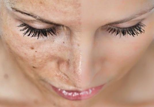 Comment enlever les taches de pigmentation?