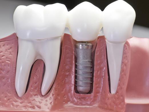 Comment les dents sont-elles insérées?