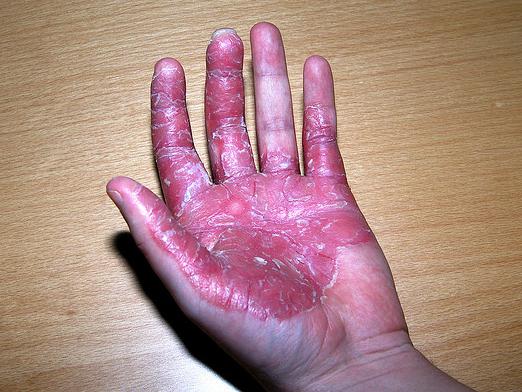 Le psoriasis est-il contagieux?