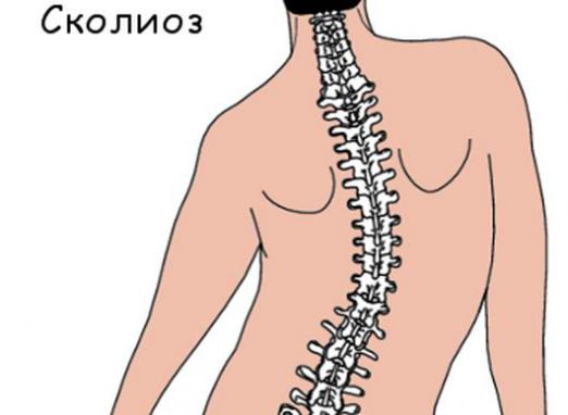 Qu'est-ce que la scoliose?