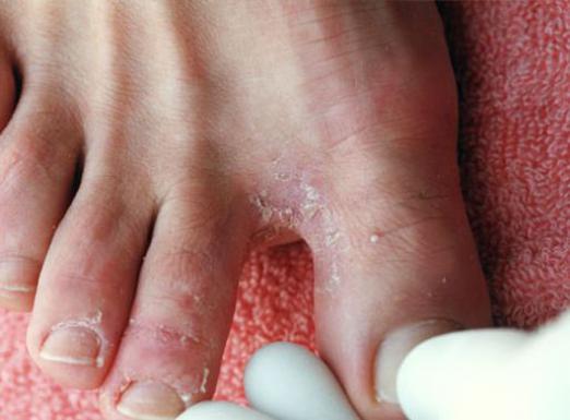 Comment guérir le mycète des pieds?