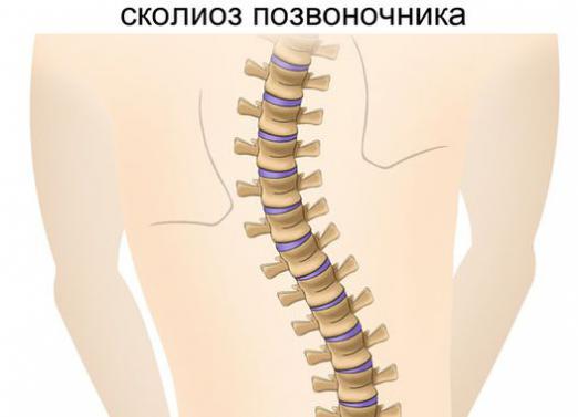 Comment guérir la scoliose?